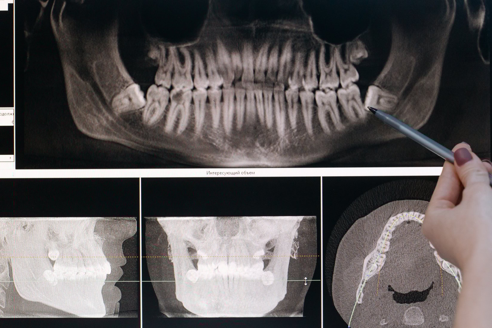 ¿Qué hace un Endodoncista?